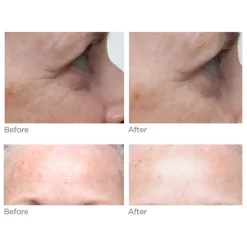 NuFACE Trinity Wrinkle Reducer (TWR) Attachment 9 NuFACE Trinity Wrinkle Reducer (TWR) Attachment -No Hair care products shop, no kiss. 11395162 6664896929482350