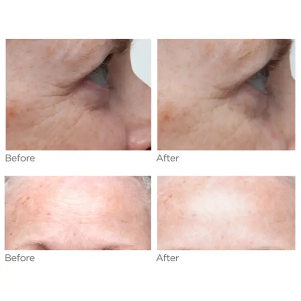 NuFACE Trinity Wrinkle Reducer (TWR) Attachment 4 NuFACE Trinity Wrinkle Reducer (TWR) Attachment - Image 2