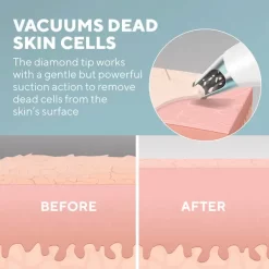 HoMedics Remove Microderm With Cooling -No Hair care products shop, no kiss. 13449404 1904937385374097